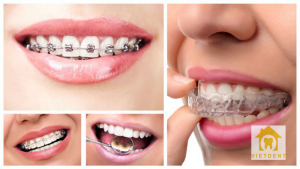 niềng răng trả góp uy tín