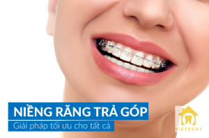 tại sao niềng răng lại đắt