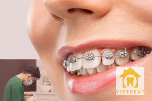 khi nào niềng răng 1 hàm