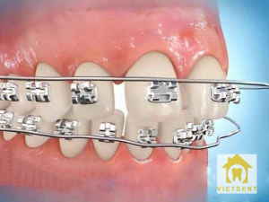 tại sao niềng răng phải nhổ răng
