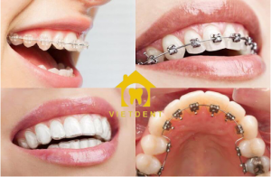 giá niềng răng hô