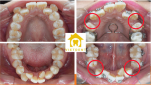 tại sao niềng răng phải nhổ răng