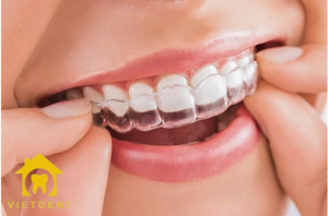 giá niềng răng invisalign