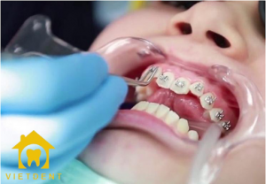niềng răng có phải nhổ không