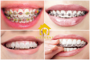 nên niềng răng loại nào