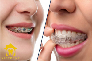 giá niềng răng invisalign